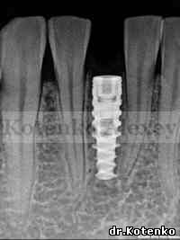 Удаление зуба и одномоментная установка имплантата АльфаБио
